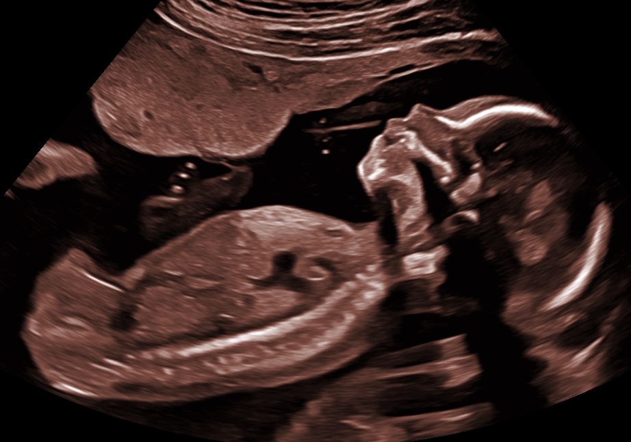 Baby Perez II — ultrasound